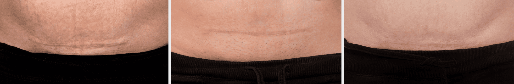 c-section
